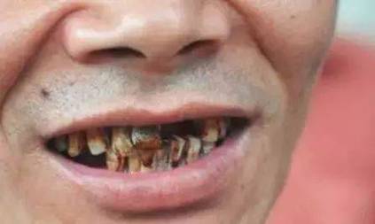 抽外烟与烂牙齿的关联，揭秘烟草对口腔健康的危害